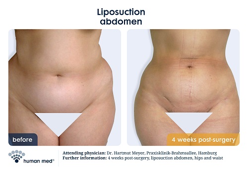 Liposuction Body - Before And After