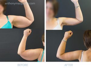 Arm Lift Surgery - before and after