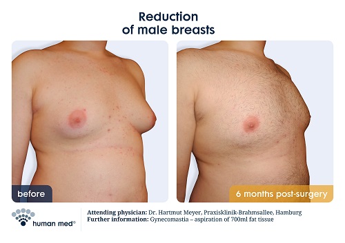 Liposuction Man Boobs - Before And After