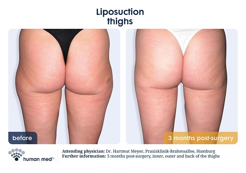 Liposuction Buttocks - Before And After