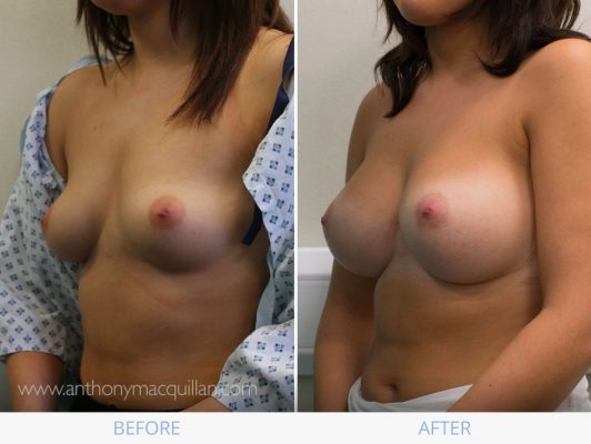 Breast Enlargement Augmentation - Before And After