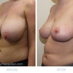 Breast reduction surgery - before and after