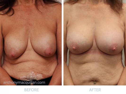 Capsular Contracture Surgery - Before And After