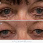 Eyelid Blepharoplasty Surgery - Reduce Eyelid Swelling