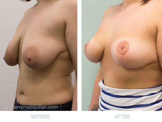 Mastopexy Uplift - Before And After