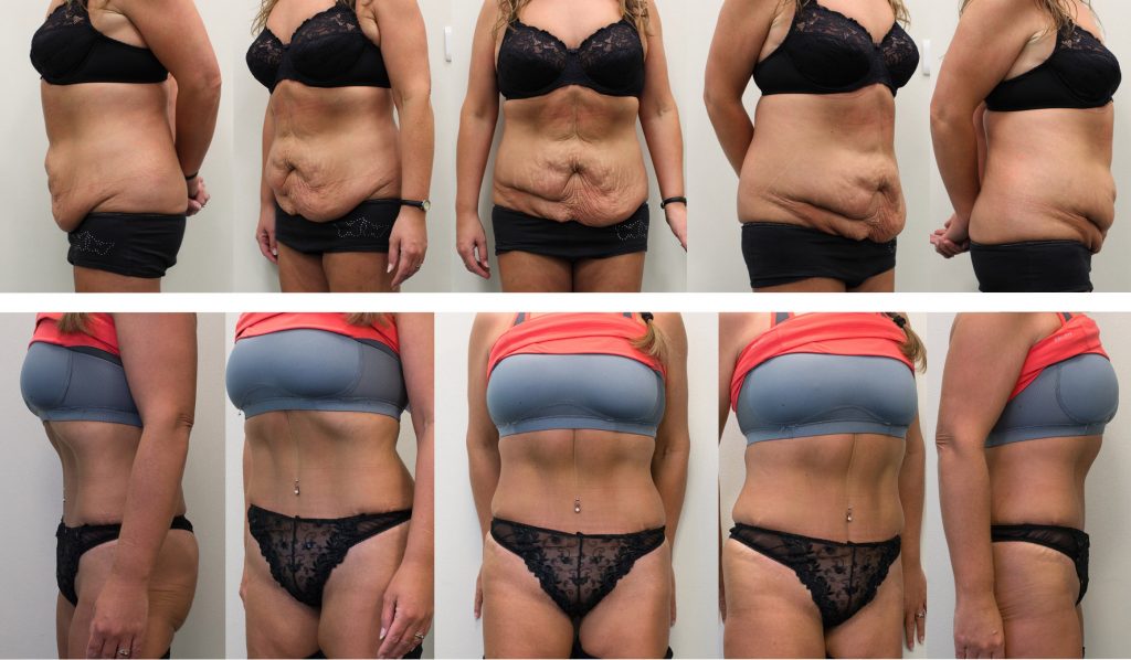 multiple photos, from different angles, showing before and after tummy tuck surgery