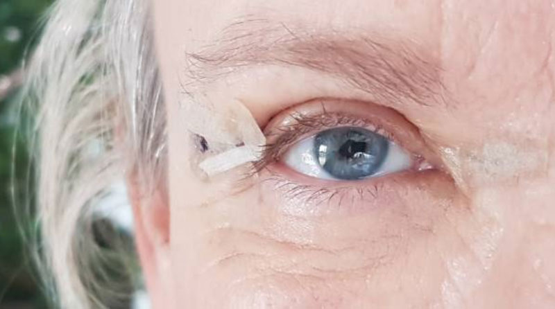 How-to-Remove-Stitches-after-Blepharoplasty