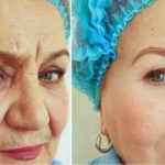 Procedures-to-Have-with-a-Facelift