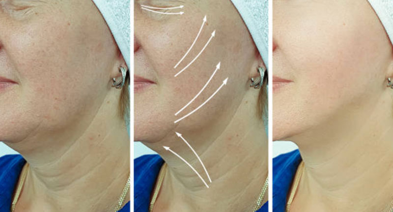 Recommendations-to-Reduce-Swelling-and-Bruising-after-Getting-Facelift-Surgery