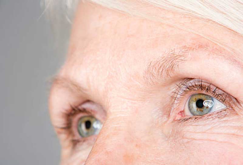 Surgical-Solutions-for-Hooded-Eyelids