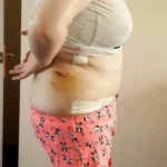 Weight Loss Left Excess Skin, Tummy Tuck, Breast Lift augmentation, Armlift Lipo Realself review bakedpotato 7