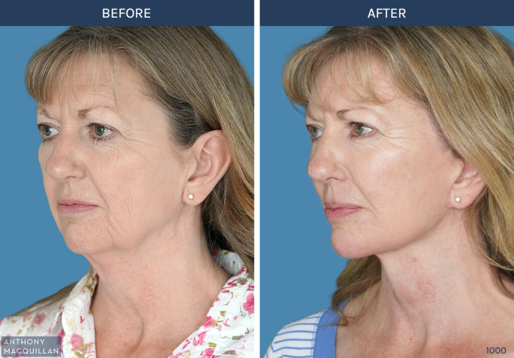 1000 - Deep Plane Face Lift with Deep Neck Lift by Anthony MacQuillan - 45 Left