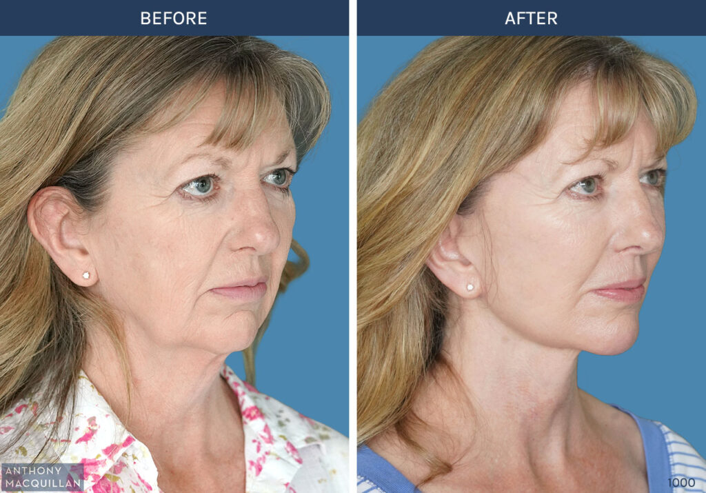 1000 - Deep Plane Face Lift with Deep Neck Lift by Anthony MacQuillan - 45 Right