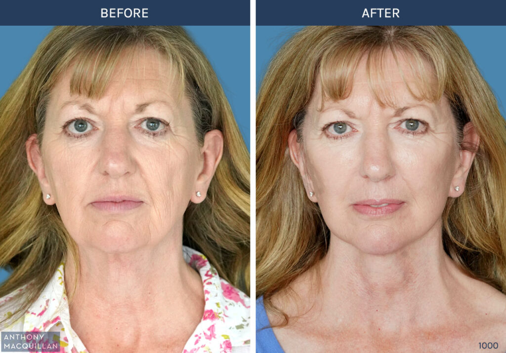 1000 - Deep Plane Face Lift with Deep Neck Lift by Anthony MacQuillan Front