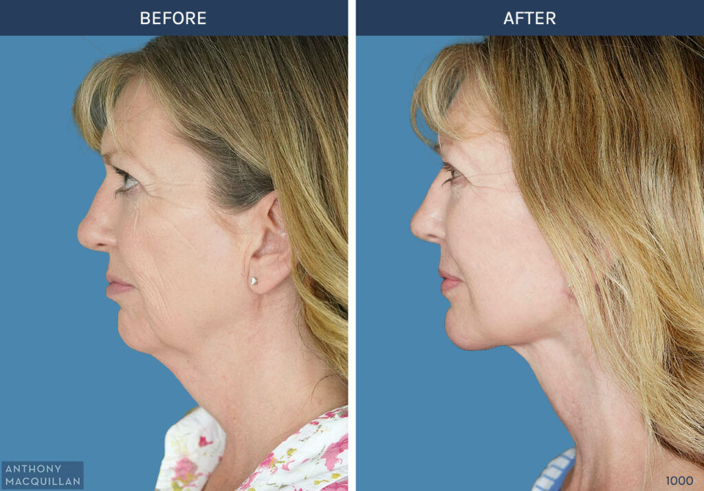 1000 - Deep Plane Face Lift with Deep Neck Lift by Anthony MacQuillan Side Left