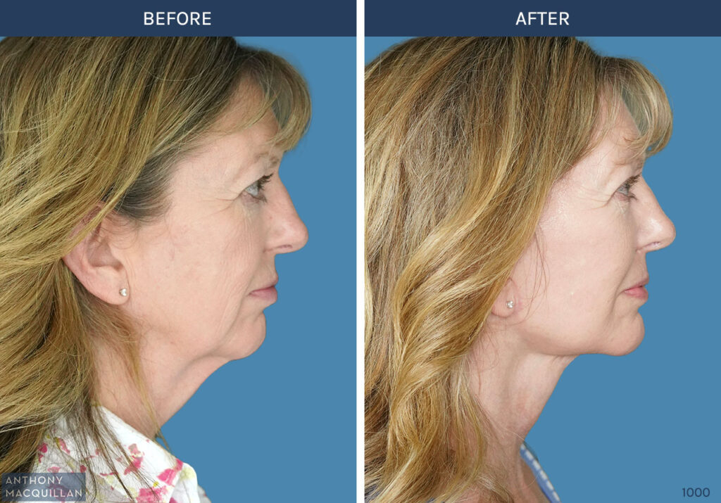 1000 - Deep Plane Face Lift with Deep Neck Lift by Anthony MacQuillan Side Right