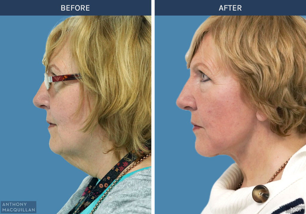 1001 - Deep Plane Face Lift with Deep Neck Lift by Anthony MacQuillan Side Left