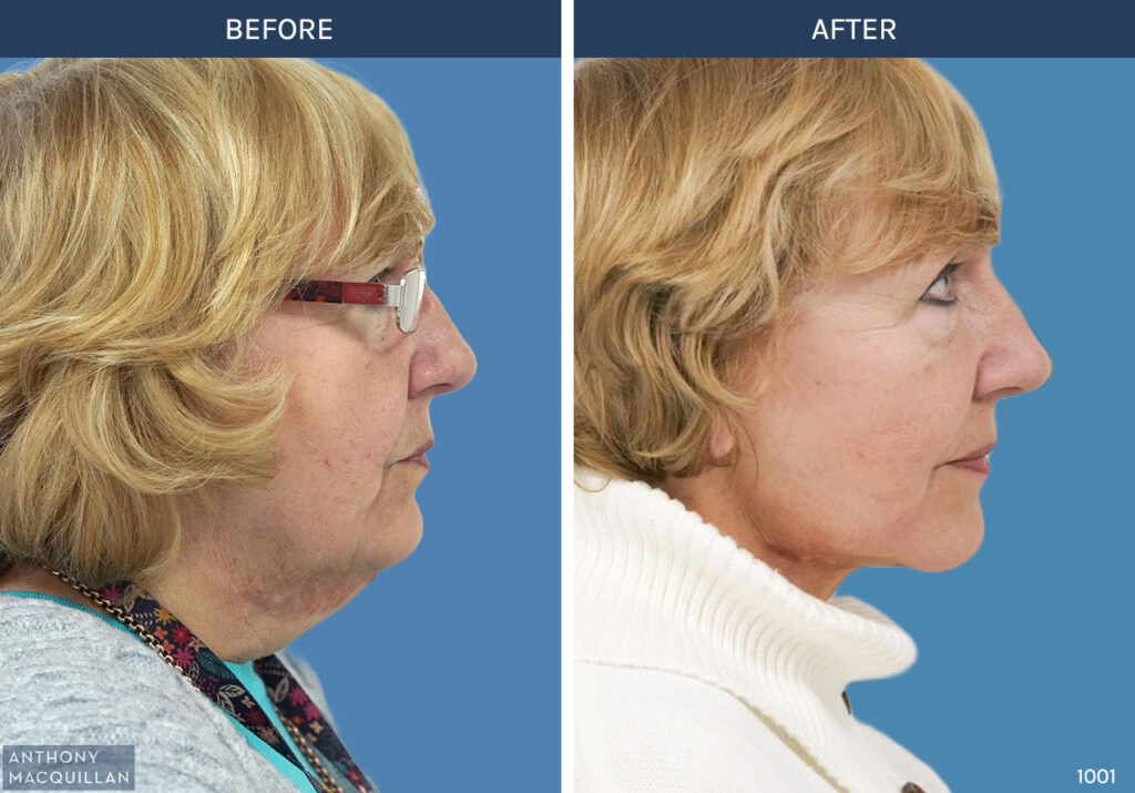 1001 - Deep Plane Face Lift with Deep Neck Lift by Anthony MacQuillan Side Right