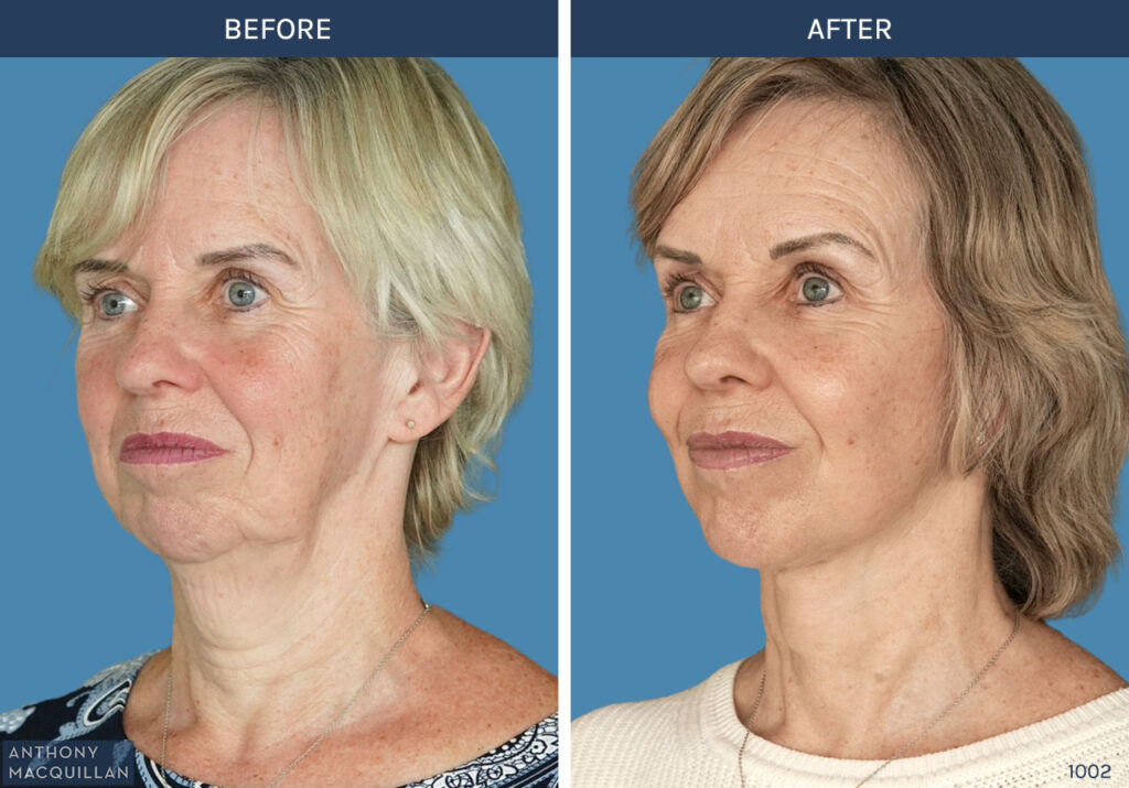 1002 - Deep Plane Face Lift with Deep Neck Lift by Anthony MacQuillan 45 Left