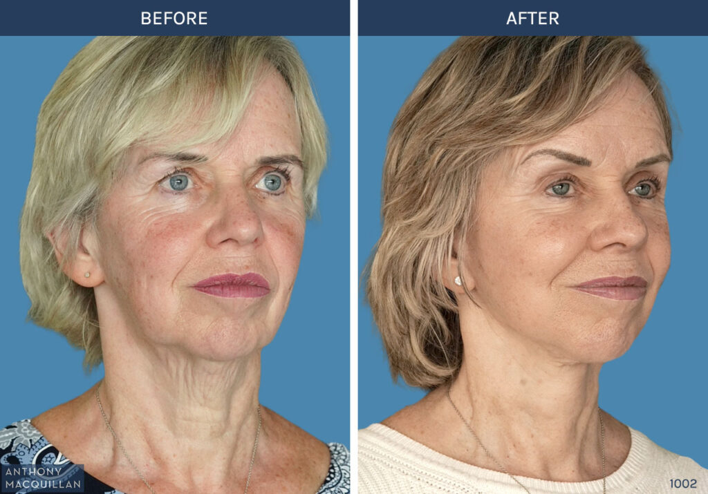 1002 - Deep Plane Face Lift with Deep Neck Lift by Anthony MacQuillan 45 Right