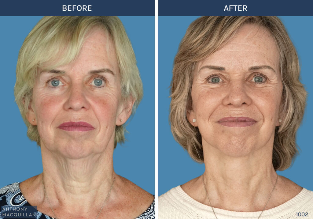 1002 - Deep Plane Face Lift with Deep Neck Lift by Anthony MacQuillan Front