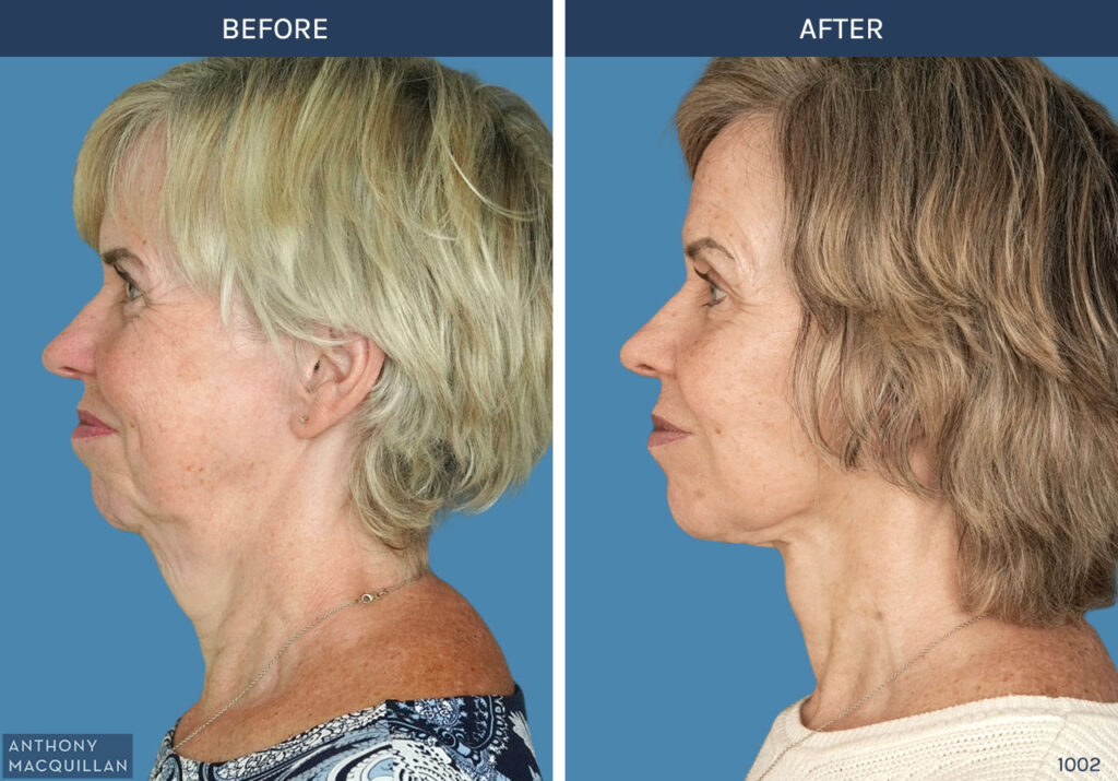1002 - Deep Plane Face Lift with Deep Neck Lift by Anthony MacQuillan Side Left
