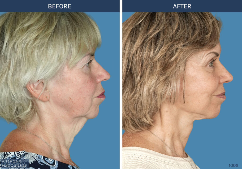 1002 - Deep Plane Face Lift with Deep Neck Lift by Anthony MacQuillan Side Right