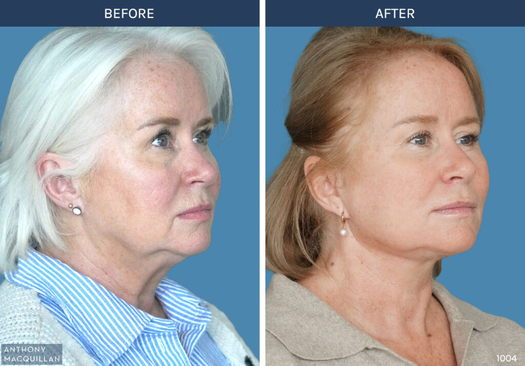 1004 - Deep Plane Face Lift with Deep Neck Lift by Anthony MacQuillan 45 Right