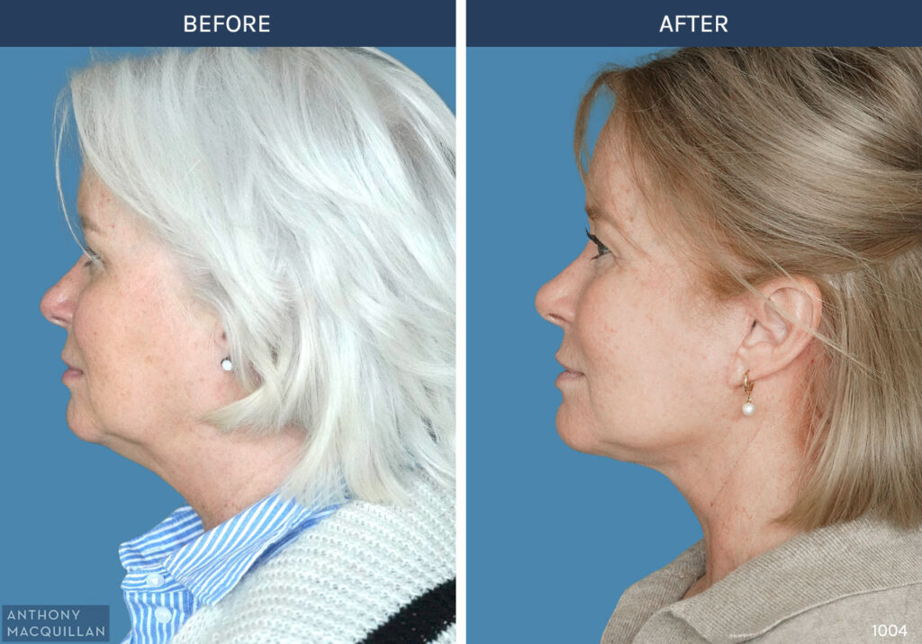 1004 - Deep Plane Face Lift with Deep Neck Lift by Anthony MacQuillan Side Left