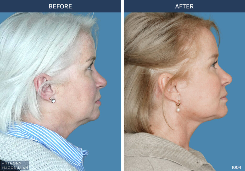 1004 - Deep Plane Face Lift with Deep Neck Lift by Anthony MacQuillan Side Right