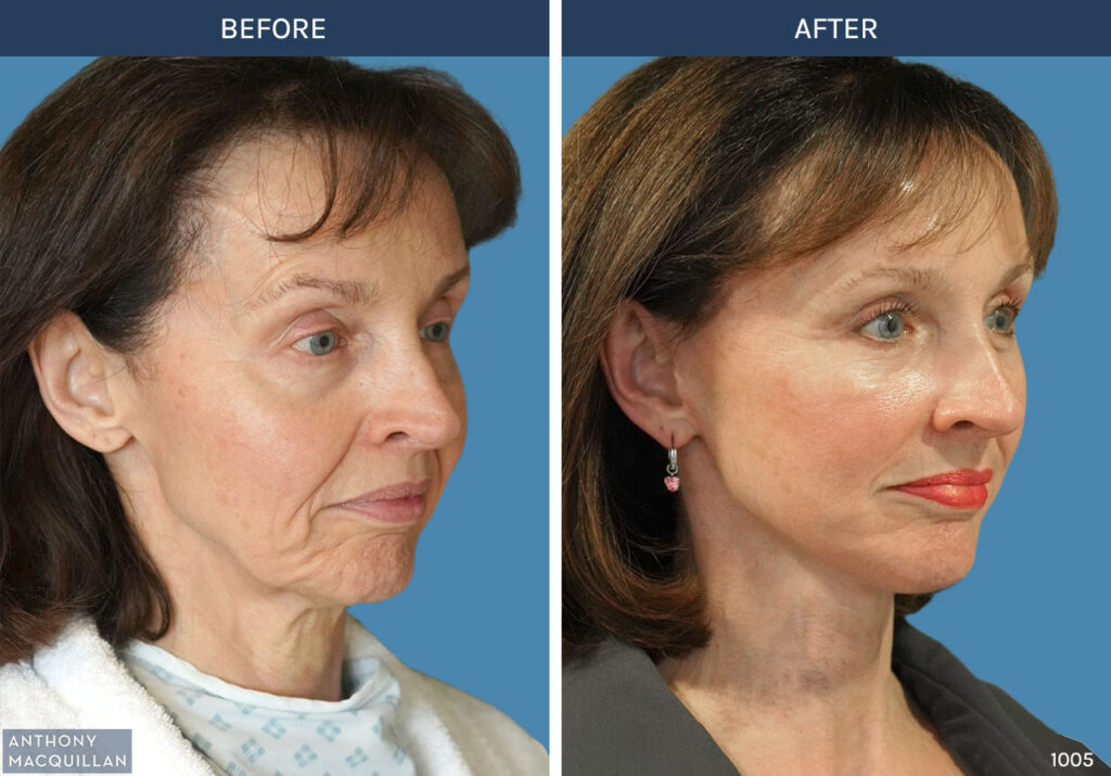 1005 - Deep Plane Face Lift with Deep Neck Lift by Anthony MacQuillan 45 Right
