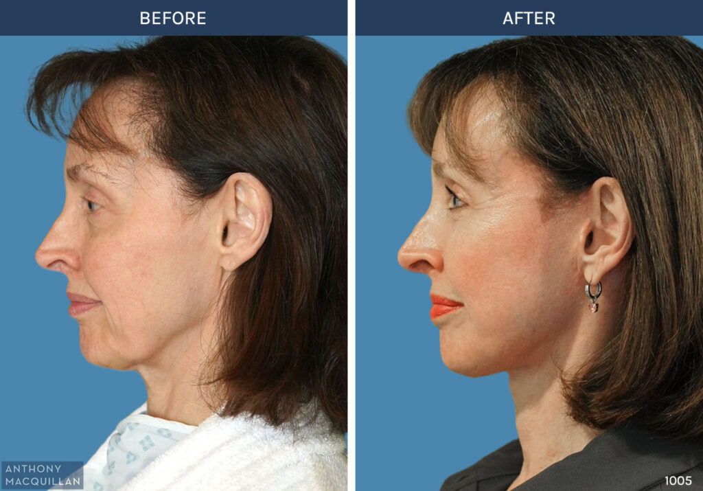 1005 - Deep Plane Face Lift with Deep Neck Lift by Anthony MacQuillan Side Left