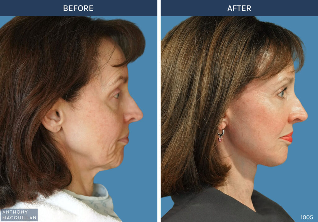 1005 - Deep Plane Face Lift with Deep Neck Lift by Anthony MacQuillan Side Right
