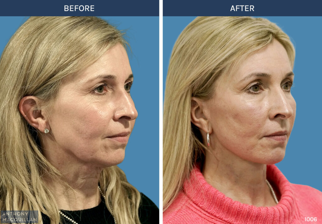 1006 - Deep Plane Face Lift with Deep Neck Lift by Anthony MacQuillan 45 Right