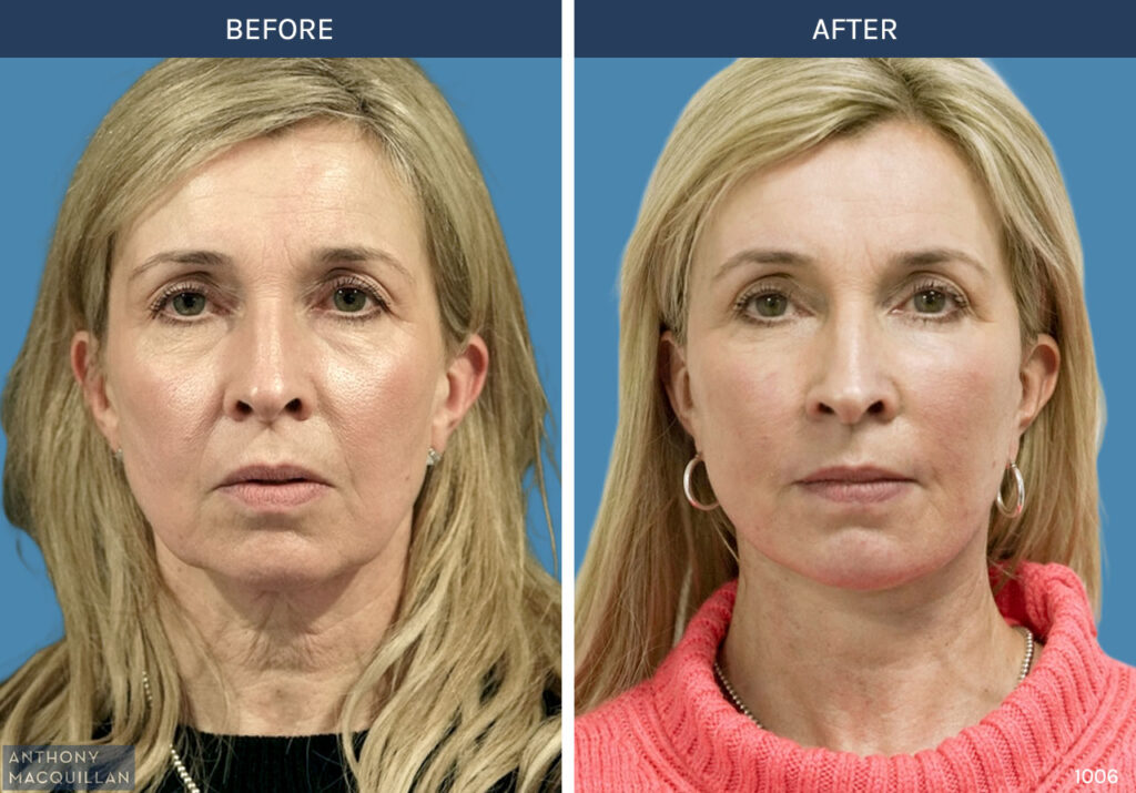 1006 - Deep Plane Face Lift with Deep Neck Lift by Anthony MacQuillan Front
