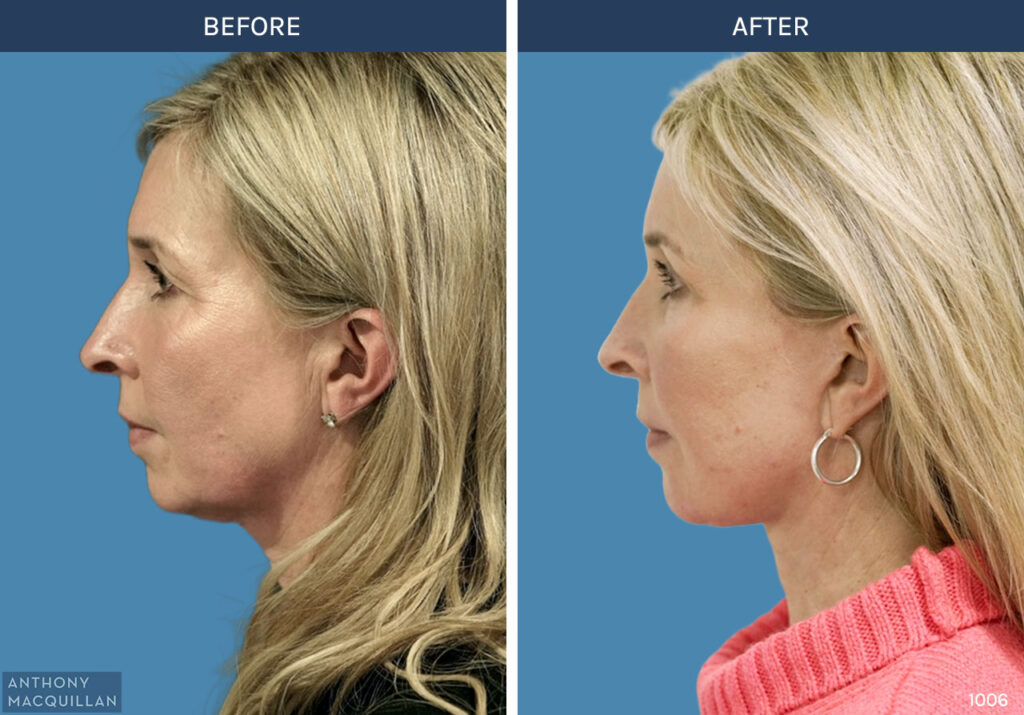 1006 - Deep Plane Face Lift with Deep Neck Lift by Anthony MacQuillan Side Left