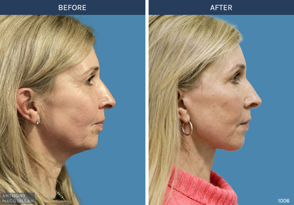 1006 - Deep Plane Face Lift with Deep Neck Lift by Anthony MacQuillan Side Right