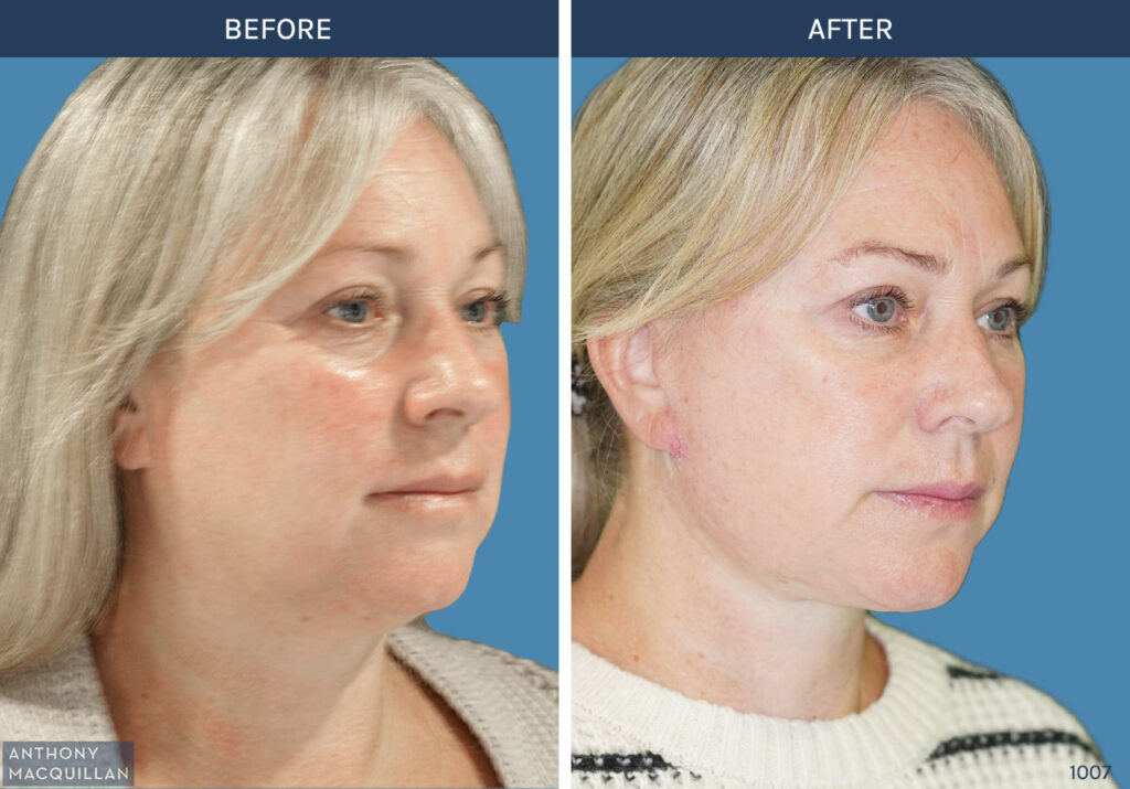 1007 - Deep Plane Face Lift with Deep Neck Lift by Anthony MacQuillan 45 Right