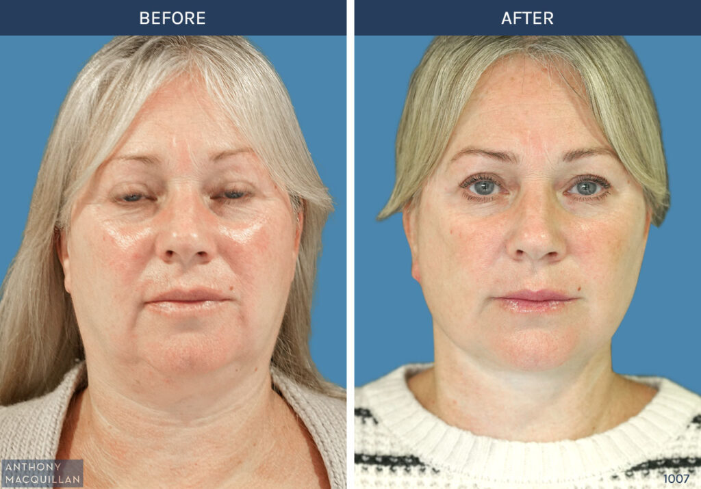 1007 - Deep Plane Face Lift with Deep Neck Lift by Anthony MacQuillan Front