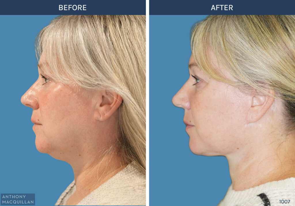 1007 - Deep Plane Face Lift with Deep Neck Lift by Anthony MacQuillan Side Left