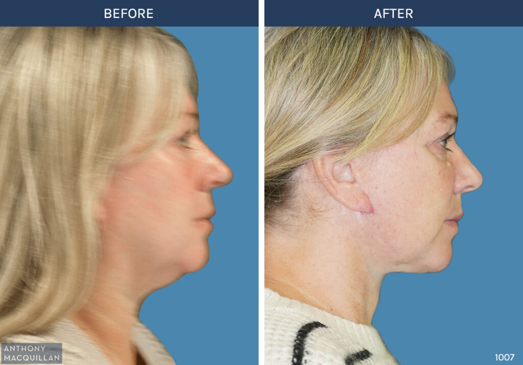 1007 - Deep Plane Face Lift with Deep Neck Lift by Anthony MacQuillan Side Right