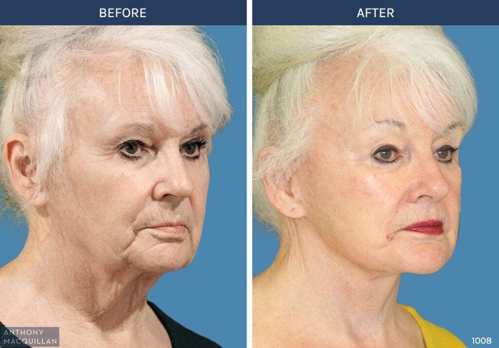 1008 - Deep Plane Face Lift with Deep Neck Lift by Anthony MacQuillan 45 Right