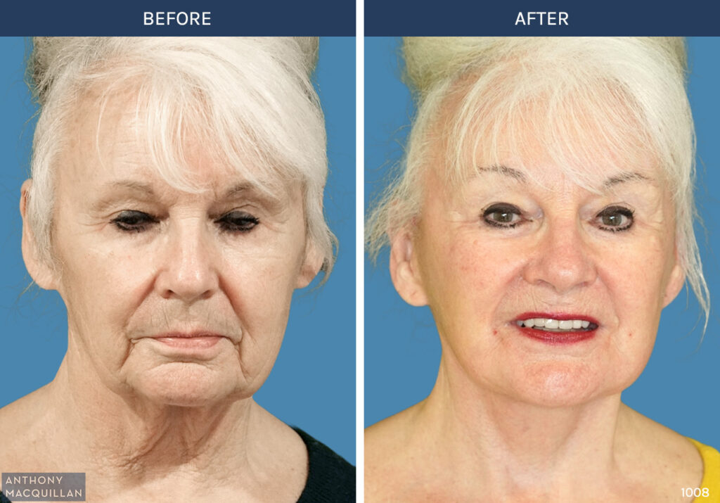 1008 - Deep Plane Face Lift with Deep Neck Lift by Anthony MacQuillan Front