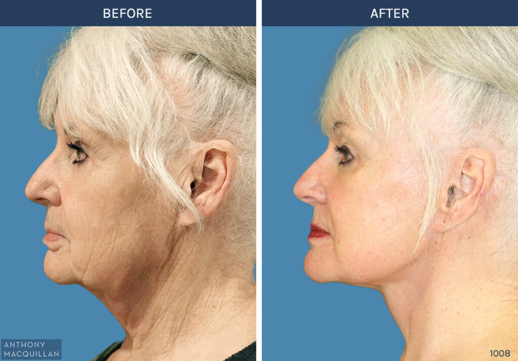 1008 - Deep Plane Face Lift with Deep Neck Lift by Anthony MacQuillan Side Left
