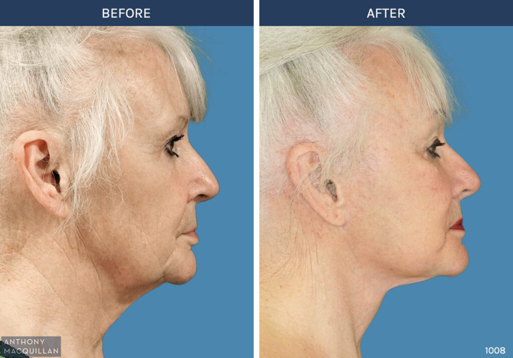 1008 - Deep Plane Face Lift with Deep Neck Lift by Anthony MacQuillan Side Right