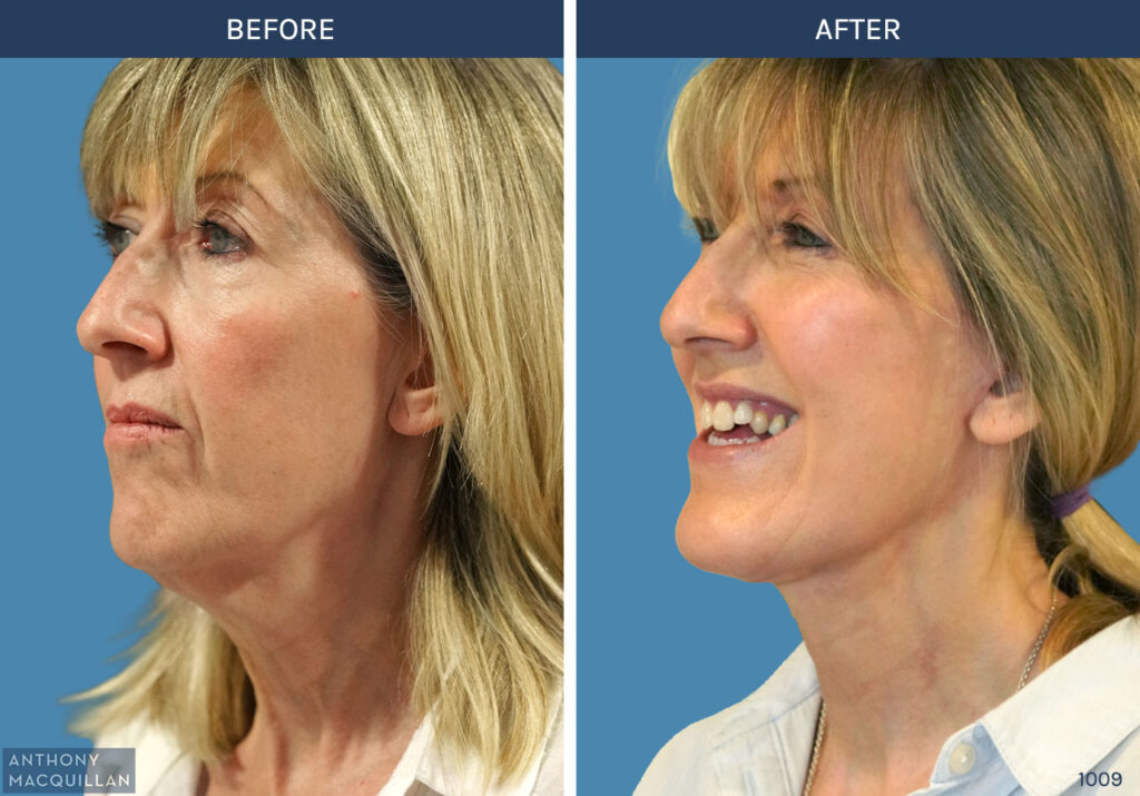 1009 - Deep Plane Face Lift with Deep Neck Lift by Anthony MacQuillan 45 Left