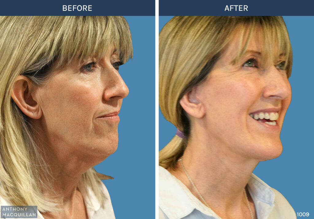 1009 - Deep Plane Face Lift with Deep Neck Lift by Anthony MacQuillan 45 Right