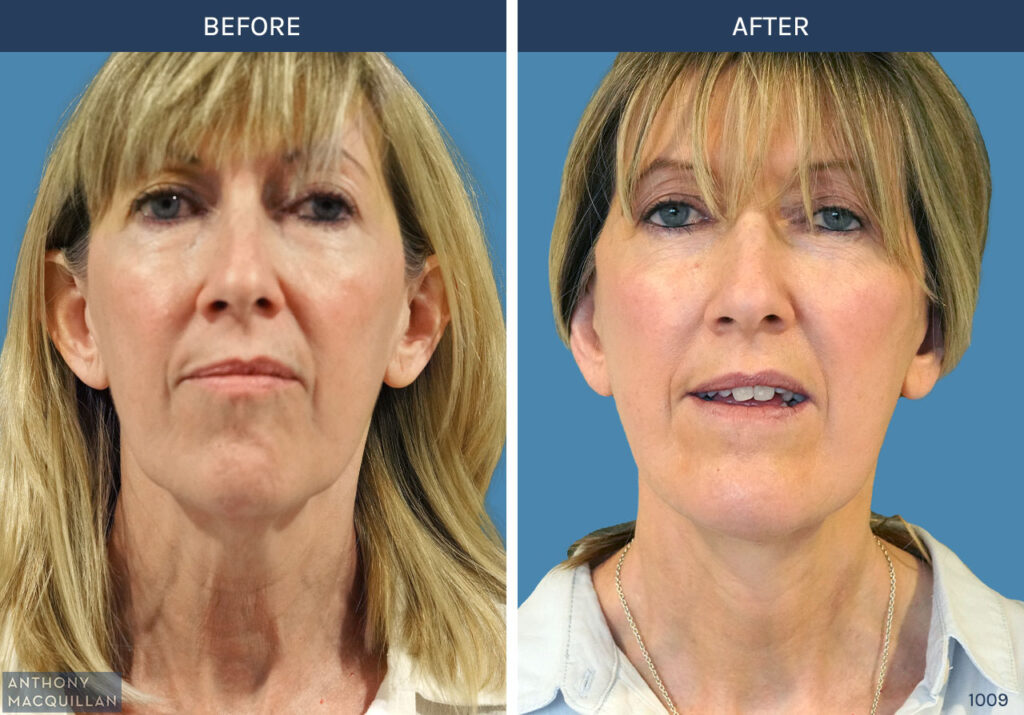1009 - Deep Plane Face Lift with Deep Neck Lift by Anthony MacQuillan Front
