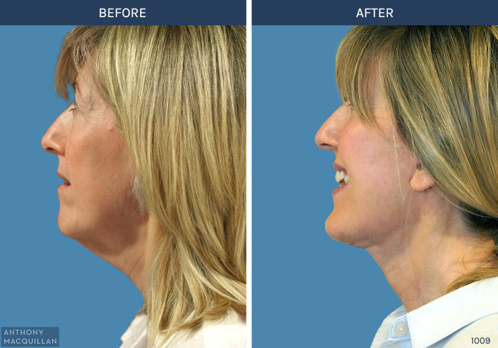 1009 - Deep Plane Face Lift with Deep Neck Lift by Anthony MacQuillan Side Left