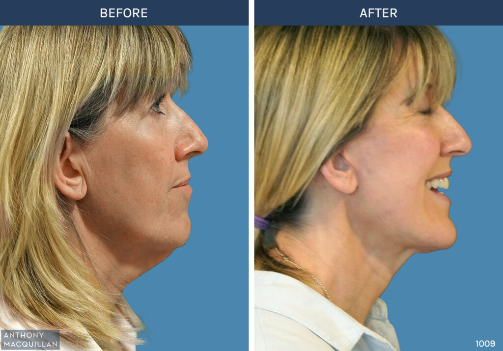 1009 - Deep Plane Face Lift with Deep Neck Lift by Anthony MacQuillan Side Right